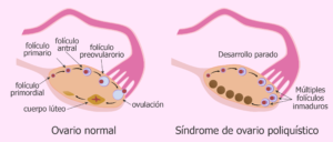 ovarios poliquistico ginecologos en guadalajara